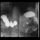 Stomach ulcer: RF - Fluoroscopy