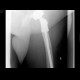 Pertrochanteric fracture of femur, osteosynthesis, refracture, total endoprosthesis: X-ray - Plain radiograph