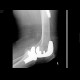 Pertrochanteric fracture of femur, osteosynthesis, refracture, total endoprosthesis: X-ray - Plain radiograph