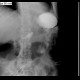 Resection of stomach, Billroth I: RF - Fluoroscopy