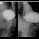 Resection of stomach, Billroth I: RF - Fluoroscopy