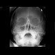 Fracture of the zygomatico-maxillary complex, left side, hemosinus: X-ray - Plain radiograph