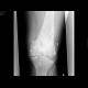 Old gunshot injury of the knee: X-ray - Plain radiograph