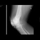 Old gunshot injury of the knee: X-ray - Plain radiograph