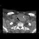 Goiter, struma: CT - Computed tomography