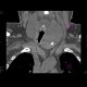 Goiter, struma: CT - Computed tomography