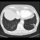 Lung embolism, subacute, lung infarct: CT - Computed tomography