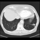 Lung embolism, subacute, lung infarct: CT - Computed tomography