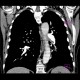 Lung embolism, subacute, lung infarct: CT - Computed tomography