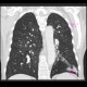 Lung embolism, subacute, lung infarct: CT - Computed tomography