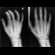 Subcapital fracture of the fourth metacarpal bone: X-ray - Plain radiograph