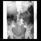 Arthrosis of SI joint: X-ray - Plain radiograph