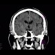Subdural hematoma, tentorium cerebelli: CT - Computed tomography