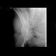 Subcapital fracture of femur: X-ray - Plain radiograph