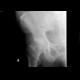 Subcapital fracture of femur: X-ray - Plain radiograph