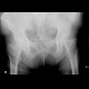 Subcapital fracture of femur: X-ray - Plain radiograph