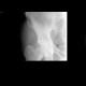 Subcapital fracture of femur: X-ray - Plain radiograph