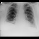 Pleural effusion, subpulmonary: X-ray - Plain radiograph