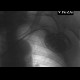 Outline of scapula, shoulder blade, mimic of pneumothorax: X-ray - Plain radiograph