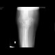 Supracondylic fracture of humerus: X-ray - Plain radiograph