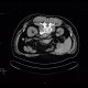 Sympatectomy, alcohol ablation of the coeliac ganglion, CT guided: CT - Computed tomography