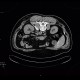 Sympatectomy, alcohol ablation of the coeliac ganglion, CT guided: CT - Computed tomography