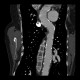 Takayashu arteritis: CT - Computed tomography