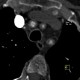 Takayashu arteritis: CT - Computed tomography