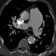 Takayashu arteritis: CT - Computed tomography