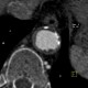 Takayashu arteritis: CT - Computed tomography