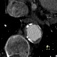 Takayashu arteritis: CT - Computed tomography