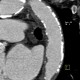 Takayashu arteritis: CT - Computed tomography