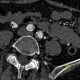 Takayashu arteritis: CT - Computed tomography