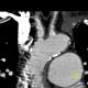 Takayashu arteritis: CT - Computed tomography