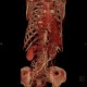 Takayashu arteritis: CT - Computed tomography