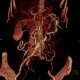 Takayashu arteritis: CT - Computed tomography