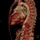 Takayashu arteritis: CT - Computed tomography