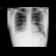 Lung tuberculosis, cavern, endobronchial spread, tree-in-bud: X-ray - Plain radiograph