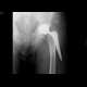 Failure of the hip replacement: X-ray - Plain radiograph