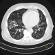 Terminal bronchiolitis, tree-in-bud: CT - Computed tomography