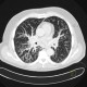 Terminal bronchiolitis, tree-in-bud: CT - Computed tomography