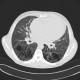Lung fibrosis, severe: CT - Computed tomography
