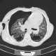 Lung fibrosis, pneumothorax: CT - Computed tomography