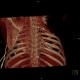 Thoracoplasty, VRT: CT - Computed tomography