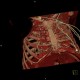 Thoracoplasty, VRT: CT - Computed tomography