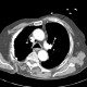 Thoracoplasty: CT - Computed tomography