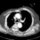 Thoracoplasty: CT - Computed tomography