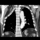 Thoracoplasty: CT - Computed tomography