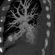 Thrombosis of the pulmonary vein: CT - Computed tomography