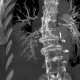 Thrombosis of the pulmonary vein: CT - Computed tomography